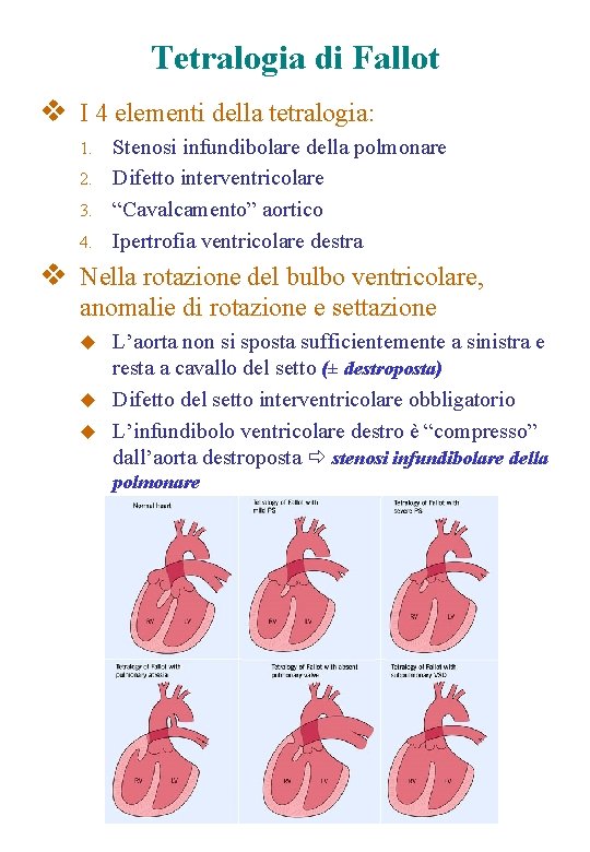 Tetralogia di Fallot v I 4 elementi della tetralogia: Stenosi infundibolare della polmonare 2.