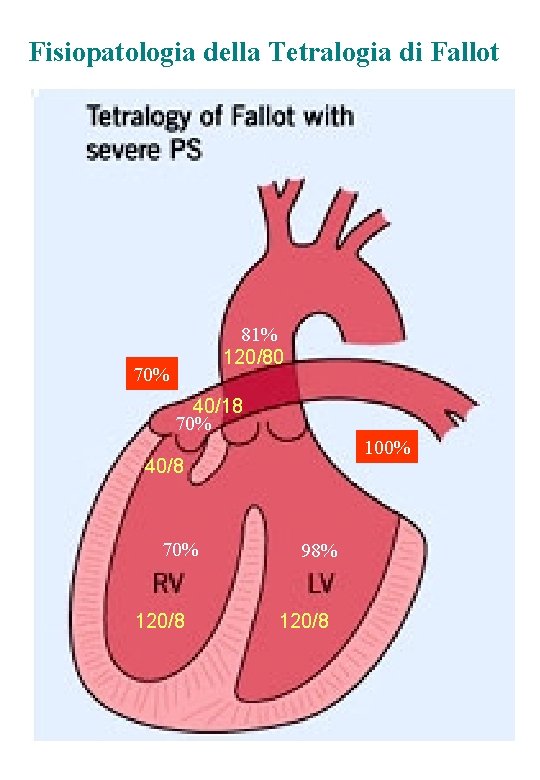 Fisiopatologia della Tetralogia di Fallot 81% 120/80 70% 40/18 70% 100% 40/8 70% 120/8