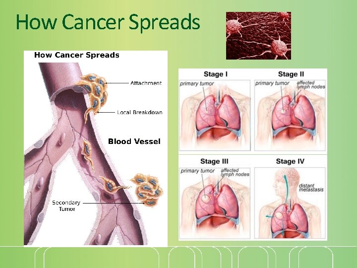 How Cancer Spreads 