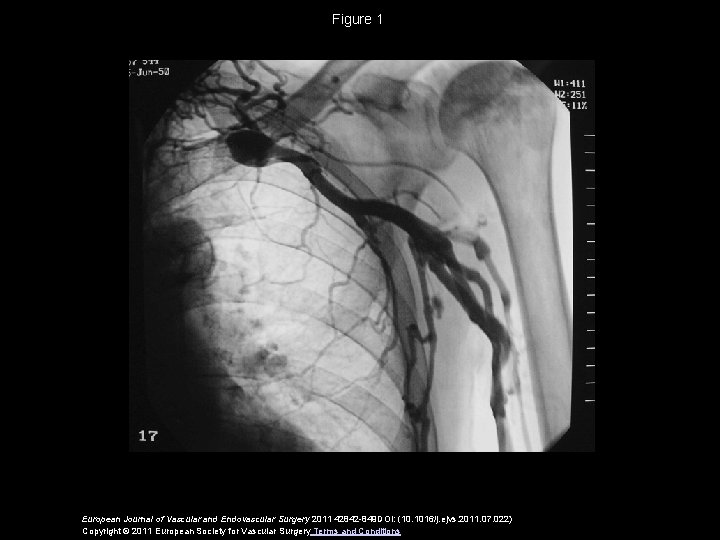 Figure 1 European Journal of Vascular and Endovascular Surgery 2011 42842 -849 DOI: (10.