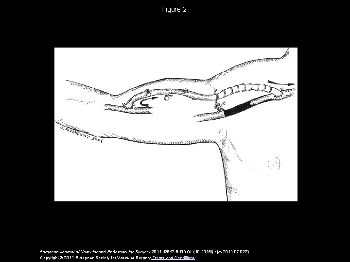 Figure 2 European Journal of Vascular and Endovascular Surgery 2011 42842 -849 DOI: (10.