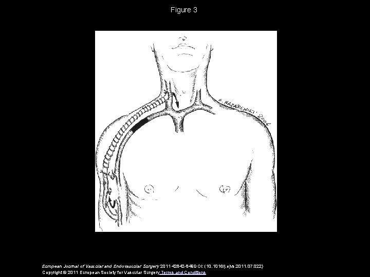 Figure 3 European Journal of Vascular and Endovascular Surgery 2011 42842 -849 DOI: (10.