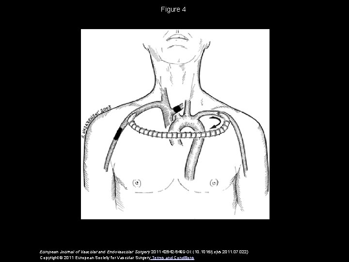 Figure 4 European Journal of Vascular and Endovascular Surgery 2011 42842 -849 DOI: (10.