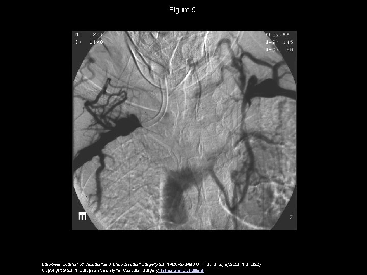 Figure 5 European Journal of Vascular and Endovascular Surgery 2011 42842 -849 DOI: (10.