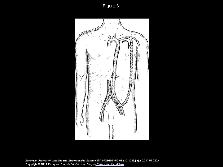 Figure 6 European Journal of Vascular and Endovascular Surgery 2011 42842 -849 DOI: (10.