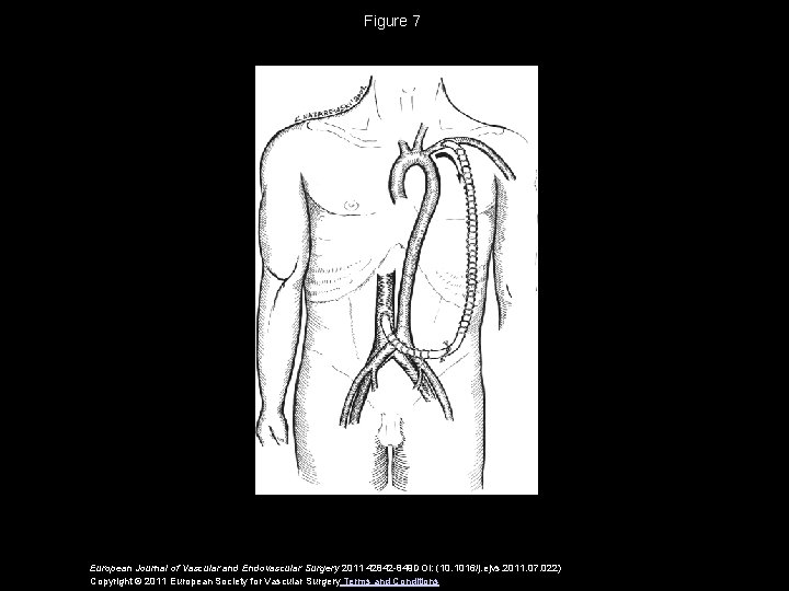 Figure 7 European Journal of Vascular and Endovascular Surgery 2011 42842 -849 DOI: (10.