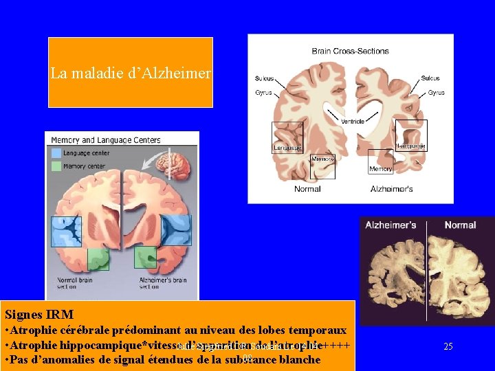 La maladie d’Alzheimer Signes IRM • Atrophie cérébrale prédominant au niveau des lobes temporaux