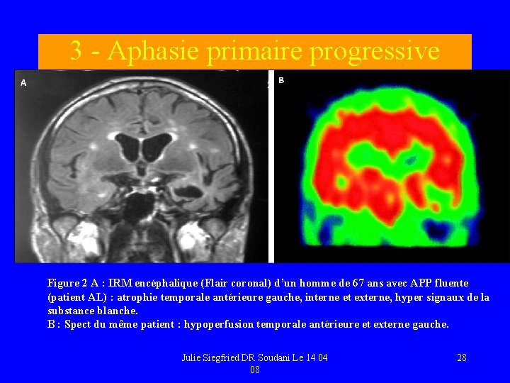 3 - Aphasie primaire progressive Illustrations Figure 2 A : IRM encéphalique (Flair coronal)
