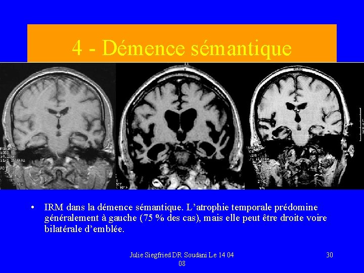 4 - Démence sémantique • IRM dans la démence sémantique. L’atrophie temporale prédomine généralement