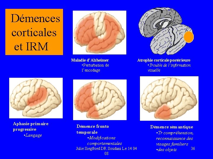  Démences corticales et IRM Aphasie primaire progressive • Langage Maladie d’Alzheimer • Perturbation