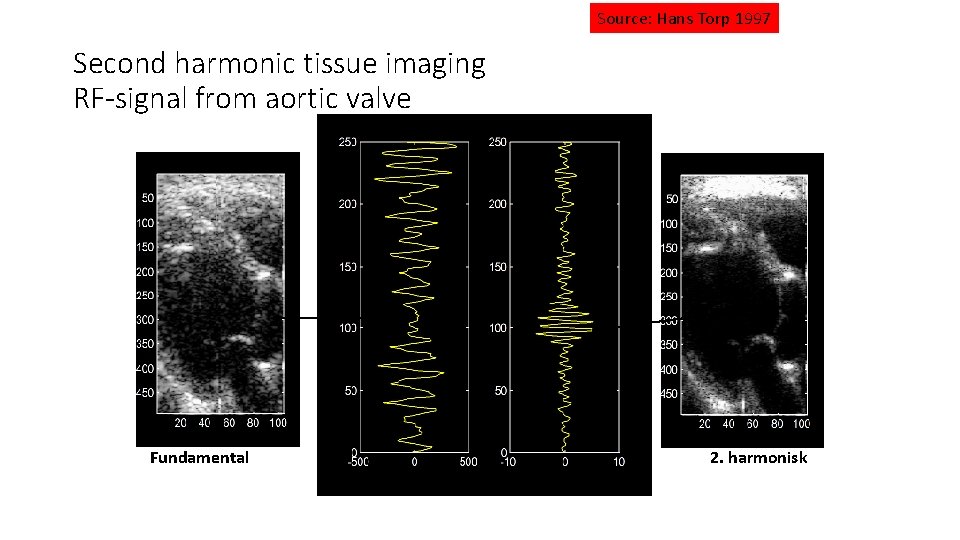 Source: Hans Torp 1997 Second harmonic tissue imaging RF-signal from aortic valve Fundamental 2.