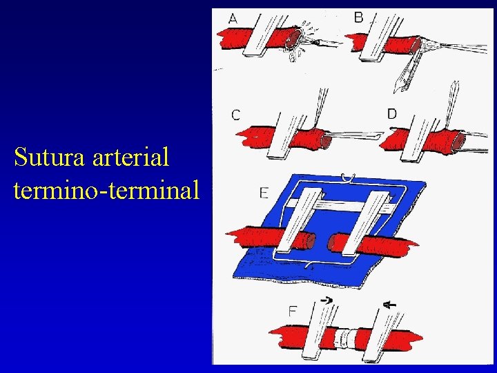 Sutura arterial termino-terminal 