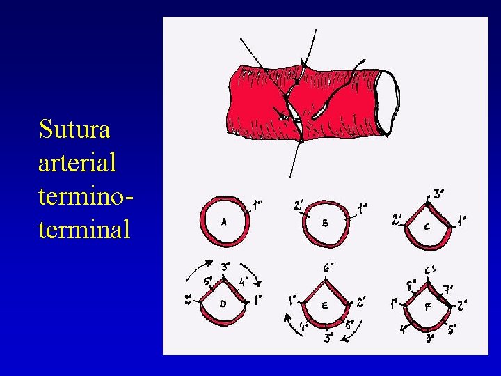 Sutura arterial terminoterminal 