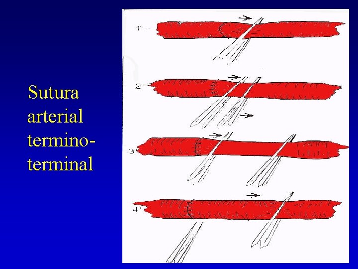 Sutura arterial terminoterminal 