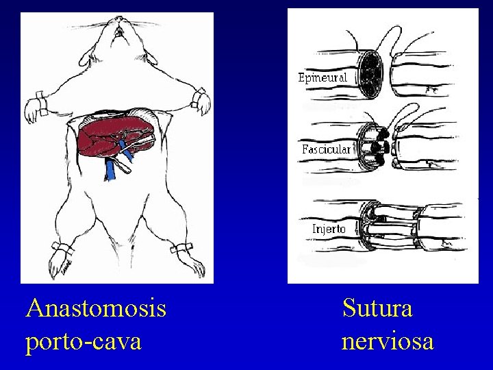 Anastomosis porto-cava Sutura nerviosa 
