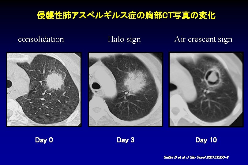 侵襲性肺アスペルギルス症の胸部CT写真の変化 consolidation Day 0 Halo sign Day 3 Air crescent sign Day 10 Caillot