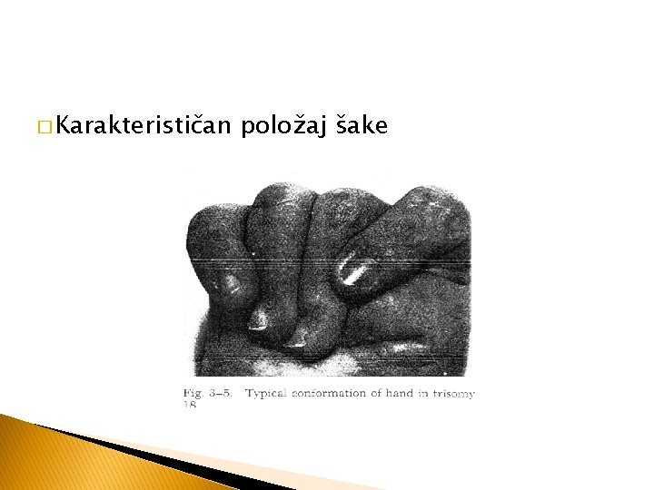 � Karakterističan položaj šake 