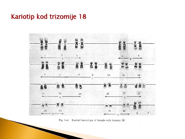 Kariotip kod trizomije 18 