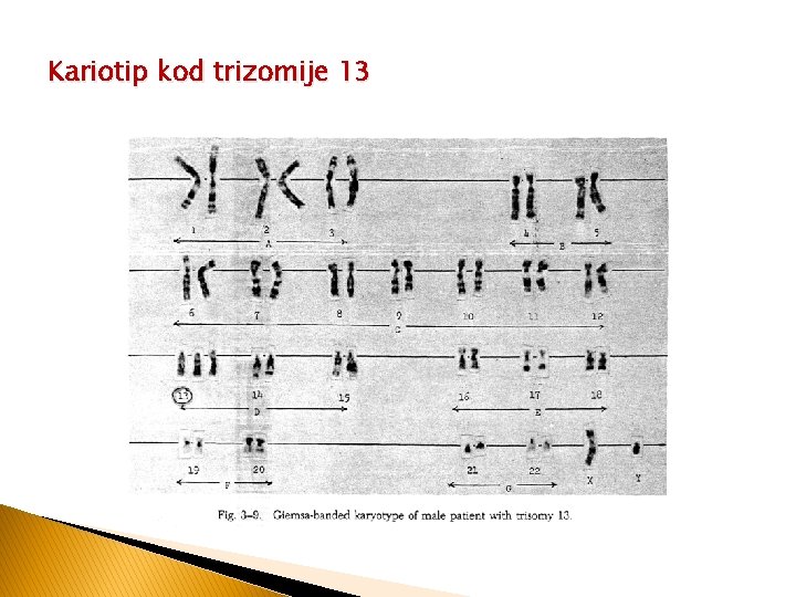 Kariotip kod trizomije 13 