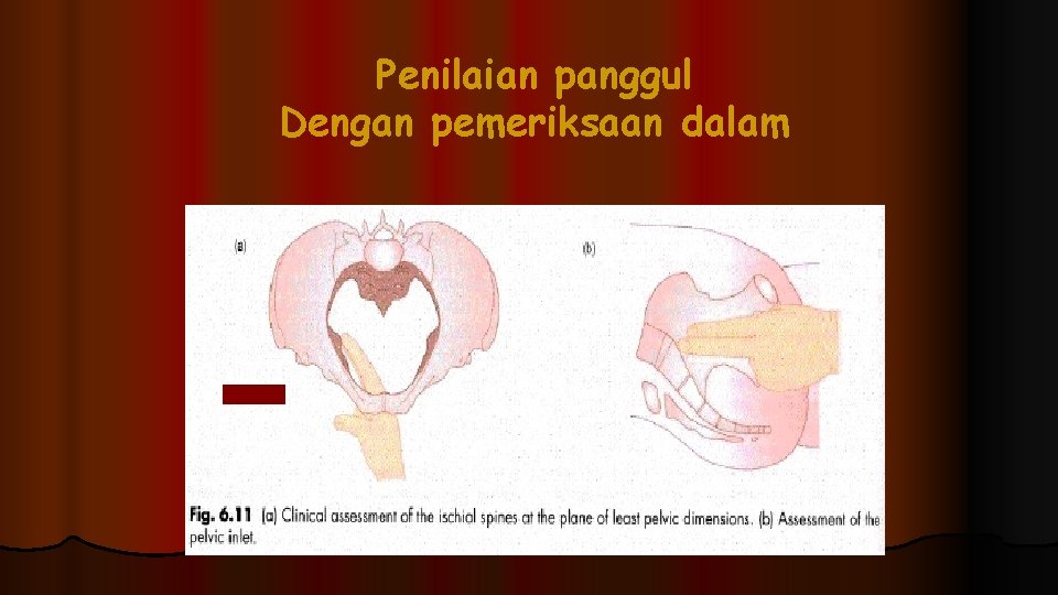 Penilaian panggul Dengan pemeriksaan dalam Penilaian panggul Dengan pemeriksaan dalam