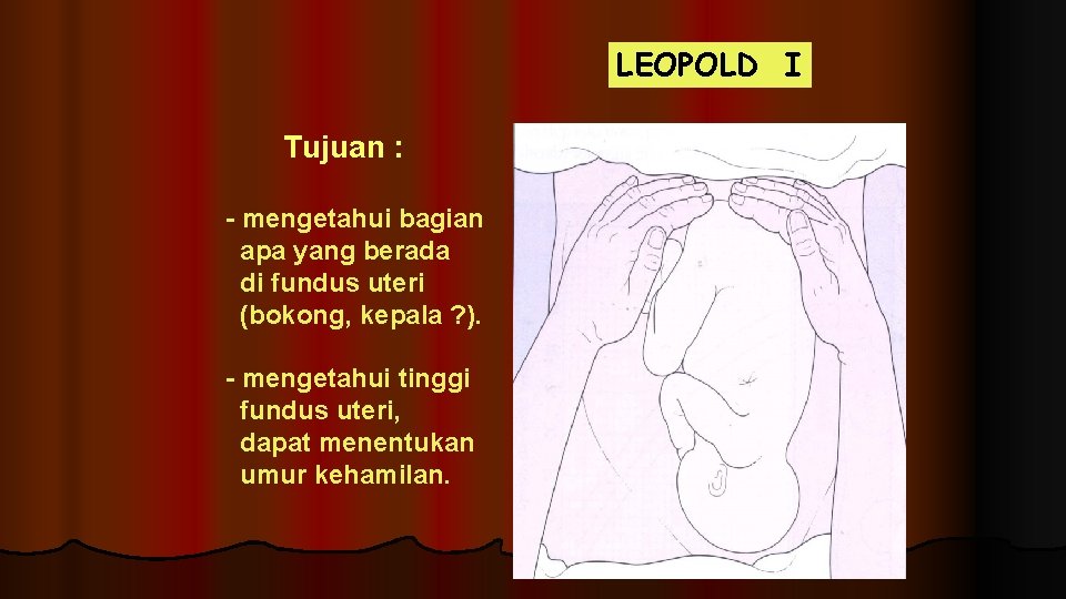 LEOPOLD I Tujuan : - mengetahui bagian apa yang berada di fundus uteri (bokong,