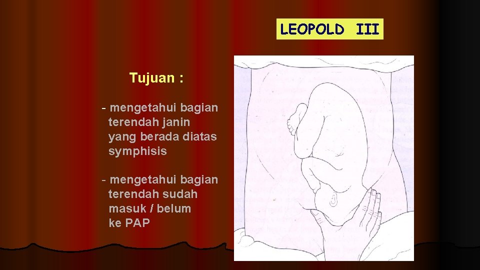 LEOPOLD III Tujuan : - mengetahui bagian terendah janin yang berada diatas symphisis -