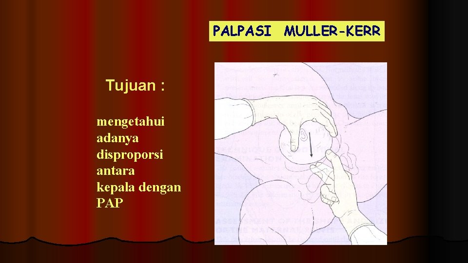 PALPASI MULLER-KERR Tujuan : mengetahui adanya disproporsi antara kepala dengan PAP PALPASI MULLER-KERR Tujuan : mengetahui adanya disproporsi antara kepala dengan PAP