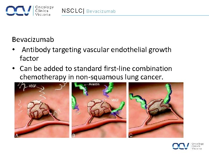 NSCLC| Bevacizumab • Antibody targeting vascular endothelial growth factor • Can be added to