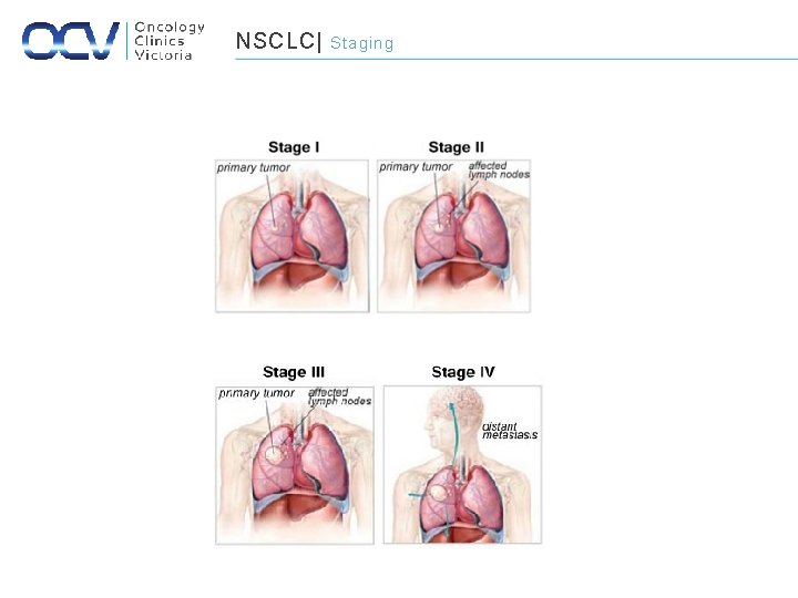 NSCLC| Staging 