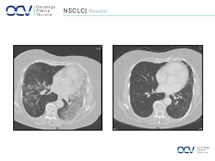 NSCLC| January 2002 Results! October 2004 