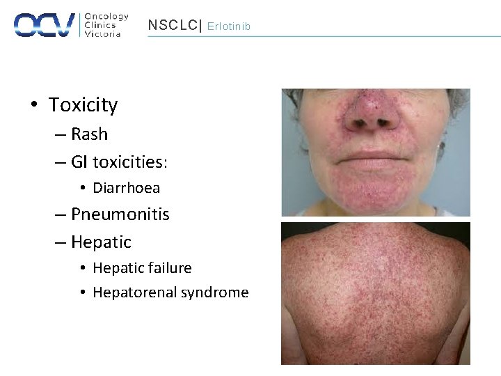 NSCLC| Erlotinib • Toxicity – Rash – GI toxicities: • Diarrhoea – Pneumonitis –
