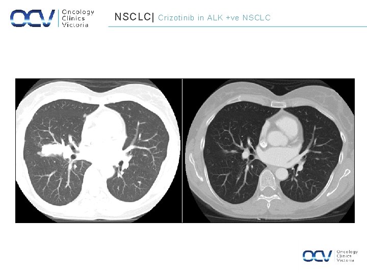NSCLC| September 2011 Crizotinib in ALK +ve NSCLC April 2012 