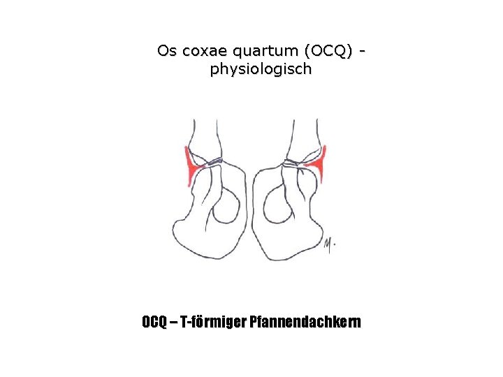 Os coxae quartum (OCQ) physiologisch OCQ – T-förmiger Pfannendachkern 