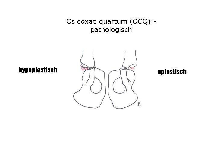 Os coxae quartum (OCQ) pathologisch hypoplastisch aplastisch 