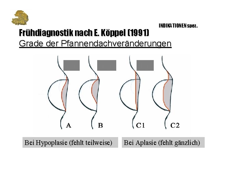 INDIKATIONEN spez. Frühdiagnostik nach E. Köppel (1991) Grade der Pfannendachveränderungen ggr. mgr. Bei Hypoplasie