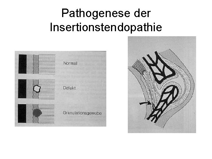 Pathogenese der Insertionstendopathie 