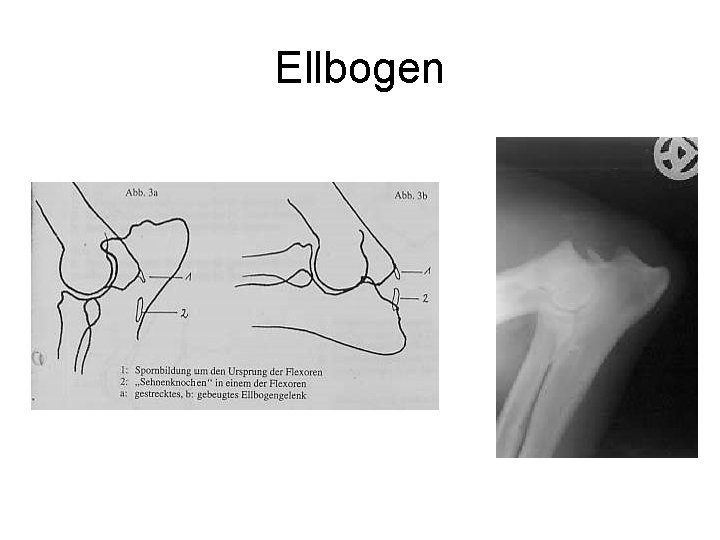 Ellbogen 