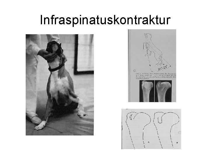 Infraspinatuskontraktur 