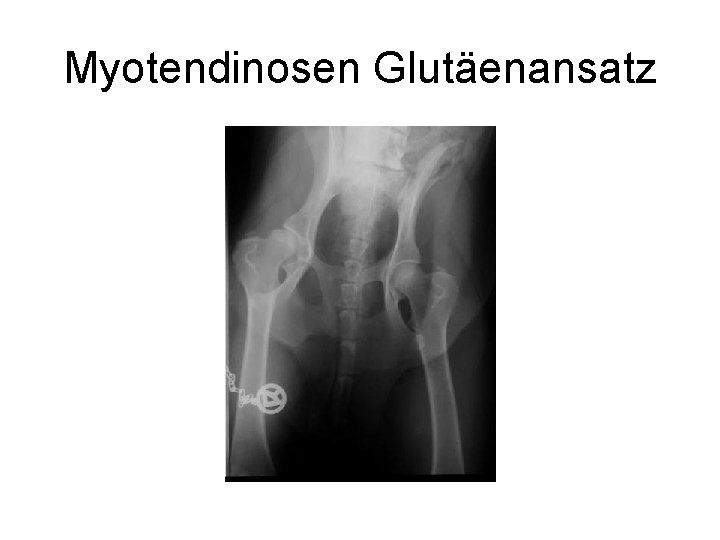 Myotendinosen Glutäenansatz 