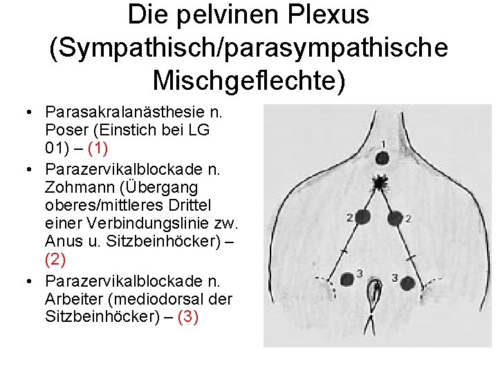 Die pelvinen Plexus (Sympathisch/parasympathische Mischgeflechte) • Parasakralanästhesie n. Poser (Einstich bei LG 01) –