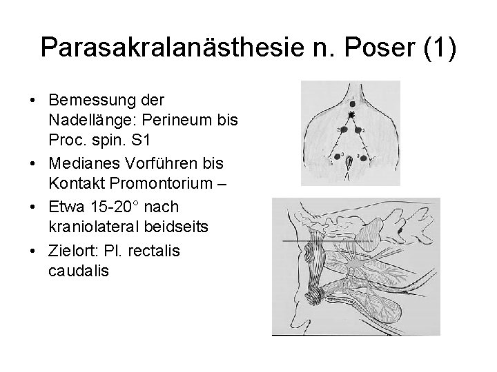 Parasakralanästhesie n. Poser (1) • Bemessung der Nadellänge: Perineum bis Proc. spin. S 1