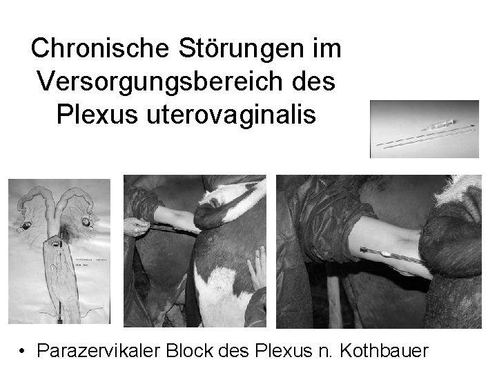 Chronische Störungen im Versorgungsbereich des Plexus uterovaginalis • Parazervikaler Block des Plexus n. Kothbauer