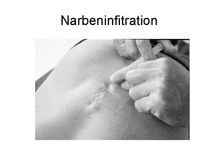 Narbeninfitration 