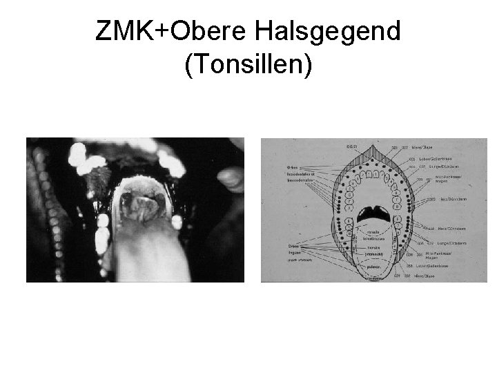 ZMK+Obere Halsgegend (Tonsillen) 