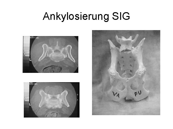 Ankylosierung SIG 