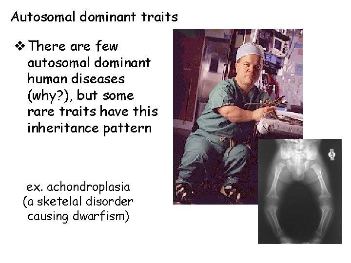 Autosomal dominant traits v There are few autosomal dominant human diseases (why? ), but