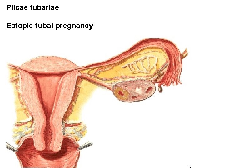 Plicae tubariae Ectopic tubal pregnancy 