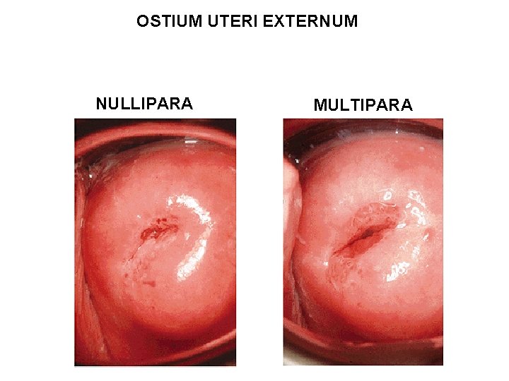 OSTIUM UTERI EXTERNUM NULLIPARA MULTIPARA 