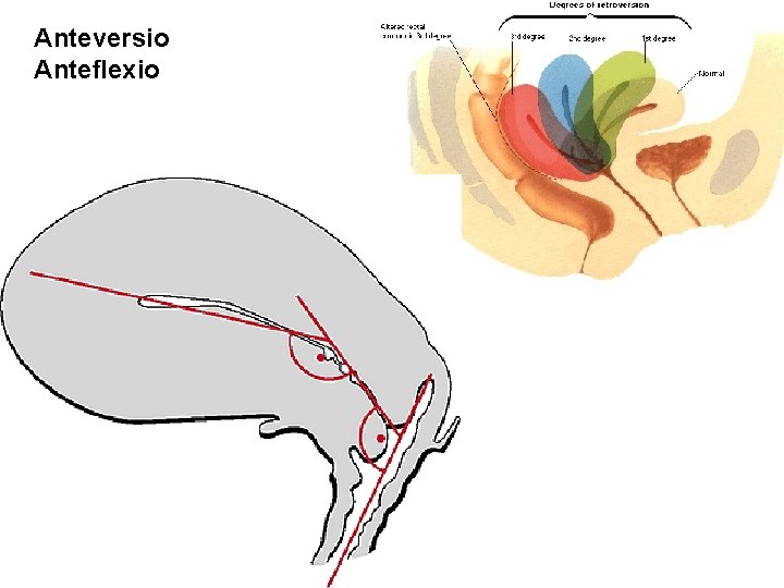 Anteversio Anteflexio 