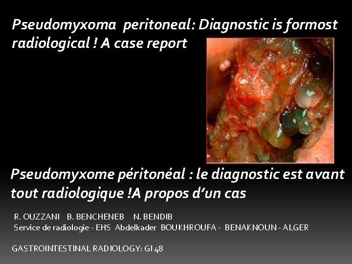 Pseudomyxoma peritoneal: Diagnostic is formost radiological ! A case report Pseudomyxome péritonéal : le